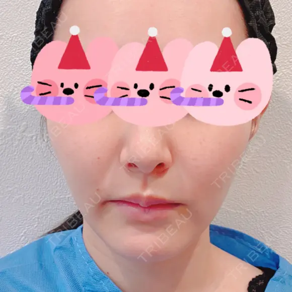 糸リフト / 脂肪吸引（顔） 東京美専クリニック BEFORE メイン用