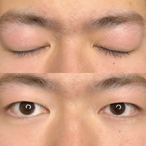 二重埋没 藤・ナチュレ美容クリニック 銀座院 BEFORE メイン用