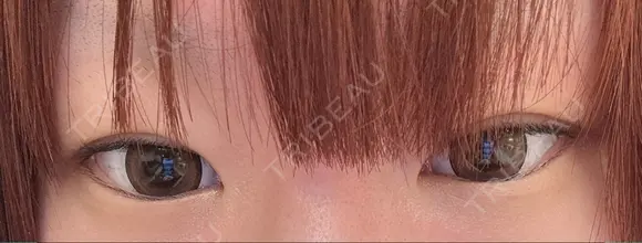 二重切開 / 目頭切開 / 眼瞼下垂（切開） オーキッド美容クリニック東京御徒町 BEFORE メイン用