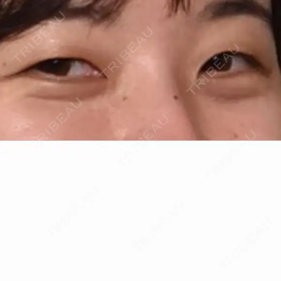 クマ治療 / 脂肪注入（肌） X CLINIC 大阪院 BEFORE メイン用