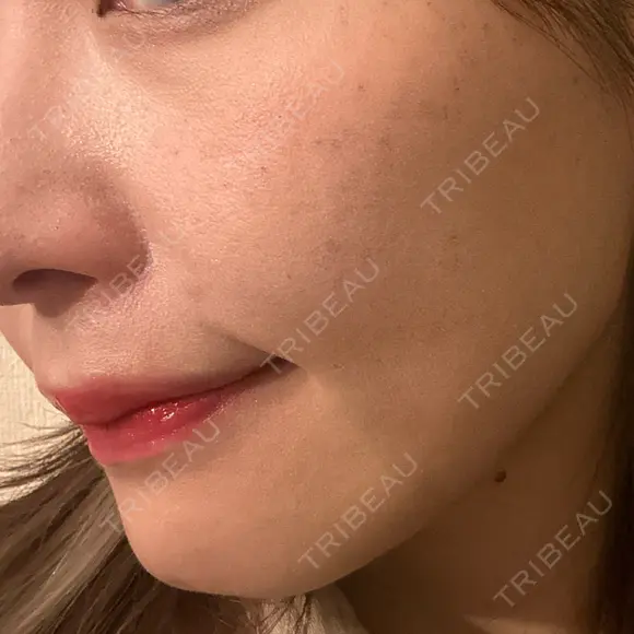 エレクトロポレーション / 毛穴洗浄（ハイドラフェイシャルなど） Re：HADA CLINIC 銀座 BEFORE メイン用