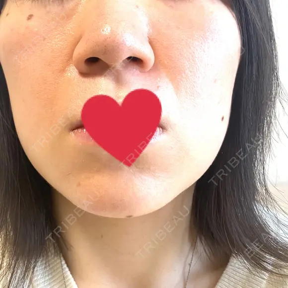 エレクトロポレーション / 毛穴洗浄（ハイドラフェイシャルなど） / ピコスポット 日比谷セントラルクリニック BEFORE メイン用