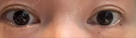目頭切開 ネビュラクリニック 京都院 BEFORE メイン用