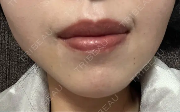 ボトックス（口角） ルラ美容クリニック 名古屋本院 BEFORE メイン用