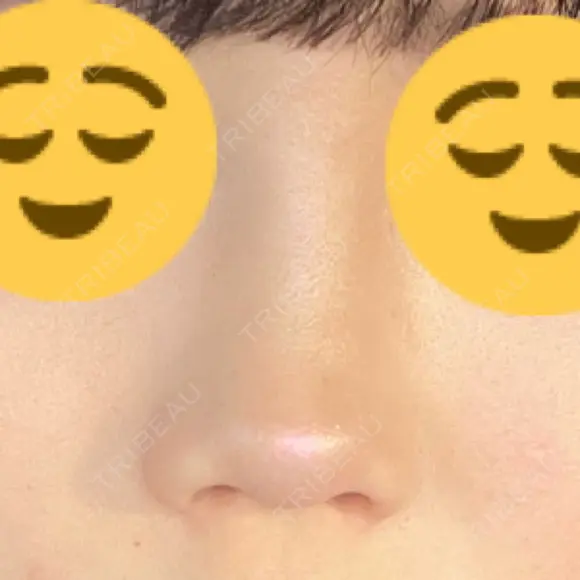 鼻尖形成（切開） / 軟骨移植 / 鼻修正 / 鼻柱下降・鼻唇角形成（猫手術） 東京シンデレラ美容外科 池袋院 BEFORE メイン用