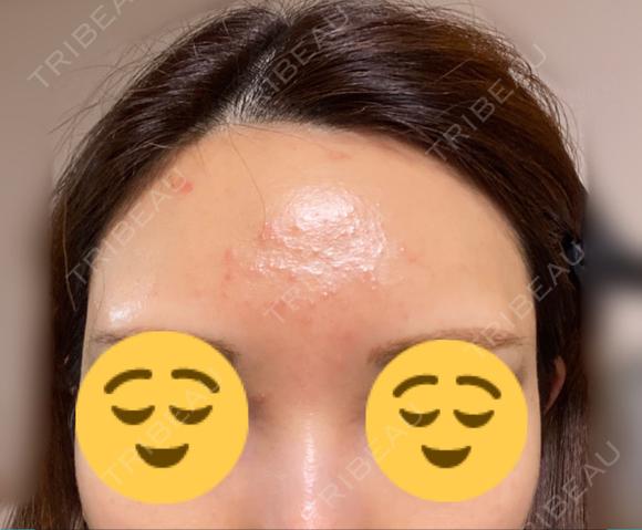 ピーリング（ニキビ・毛穴） / イオン導入 OMI CLINIC 【オミクリニック】 BEFORE メイン用