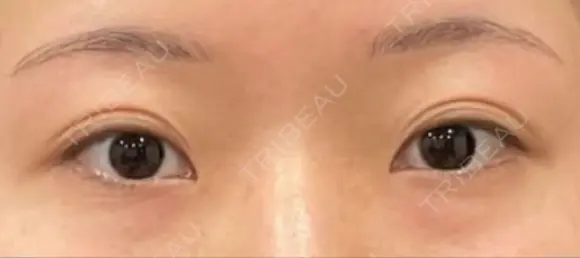 クマ治療 / 下まぶたたるみ取り / 目元修正 / 脂肪注入（目の下） / その他（目元） 吉井クリニック BEFORE メイン用