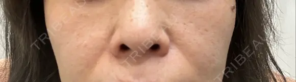 ポテンツァ 表参道メディカルクリニック 銀座院 BEFORE メイン用