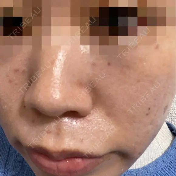 その他（肌） / 美肌レーザー / シミ取りレーザー / 美白レーザー / ピコスポット AURORA CLINIC（オーロラクリニック）新宿院 BEFORE メイン用