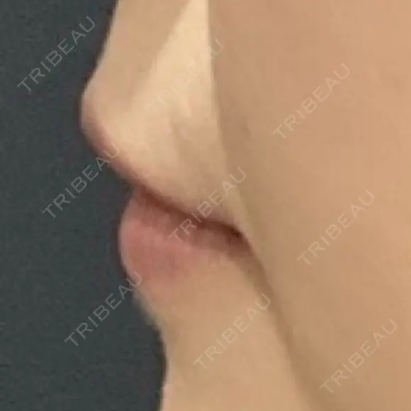 ヒアルロン酸注入（唇） LIKI CLINIC KOBE BEFORE メイン用