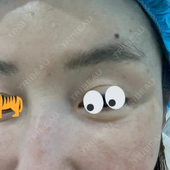 ベビーコラーゲン / サーマクール 新宿ラクル美容外科クリニック 新宿院 BEFORE メイン用