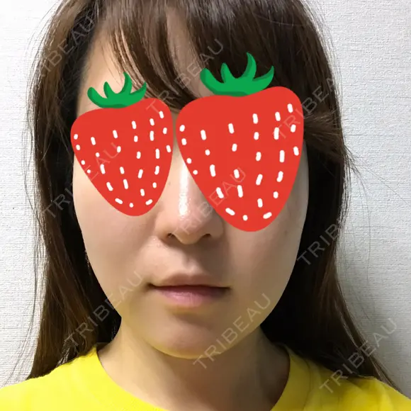 ボトックス（エラ・小顔） 湘南美容クリニック 京都院 BEFORE メイン用