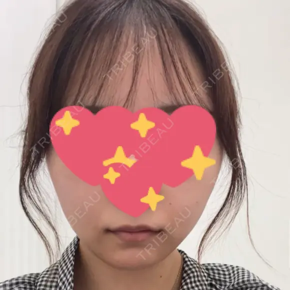 糸リフト / ボトックス（エラ・小顔） TCB東京中央美容外科 仙台駅前院 BEFORE メイン用