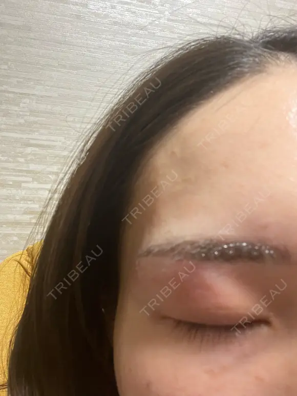 アートメイク（眉） 共立美容外科 浜松院 BEFORE メイン用