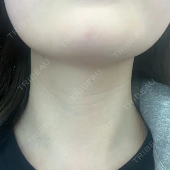 肌ヒアルロン酸注入（たるみ・シワ改善） ルラ美容クリニック 名古屋本院 BEFORE メイン用