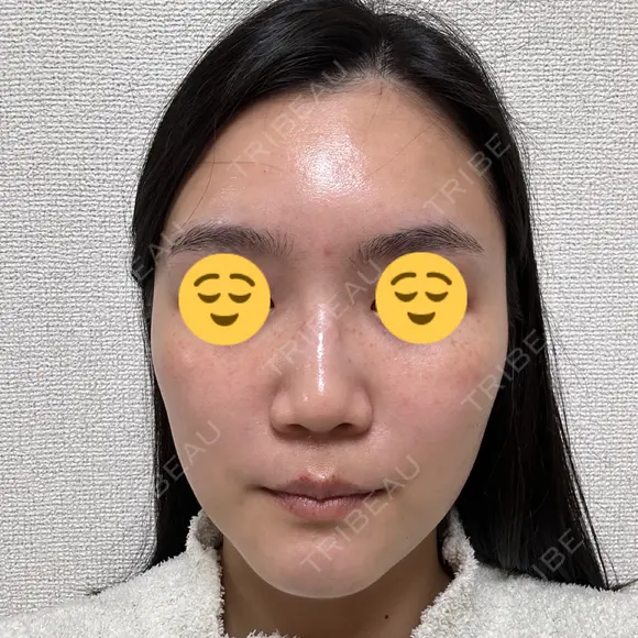 エレクトロポレーション 湘南美容クリニック Regno 銀座院 BEFORE メイン用