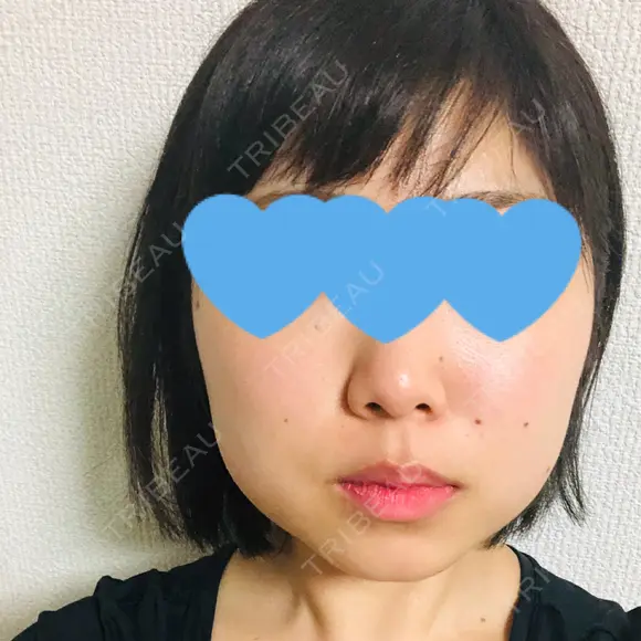脂肪吸引（顔） GRACIA clinic 【グラシアクリニック】 BEFORE メイン用