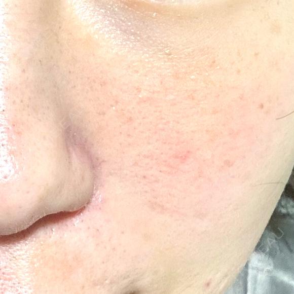 光治療（フォトフェイシャルなど） B-LINE CLINIC 池袋院 BEFORE メイン用