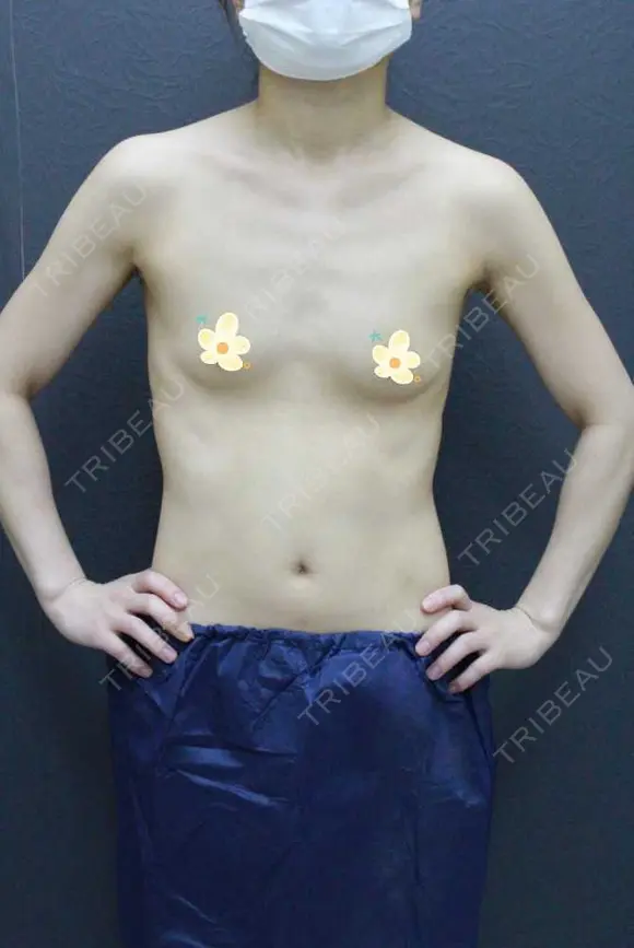 豊胸（シリコンバッグ） / 乳頭縮小 渋谷の森クリニック BEFORE メイン用