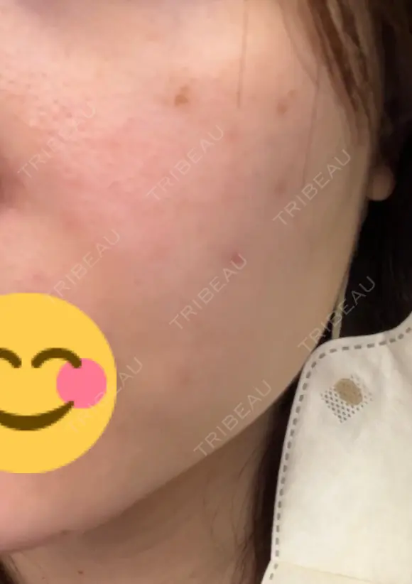 ほくろ・いぼ除去レーザー（肌） / シミ取りレーザー / ピコスポット 日比谷セントラルクリニック BEFORE メイン用