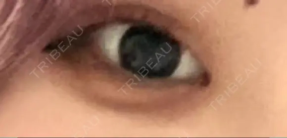 二重埋没 湘南美容クリニック 町田院 BEFORE メイン用