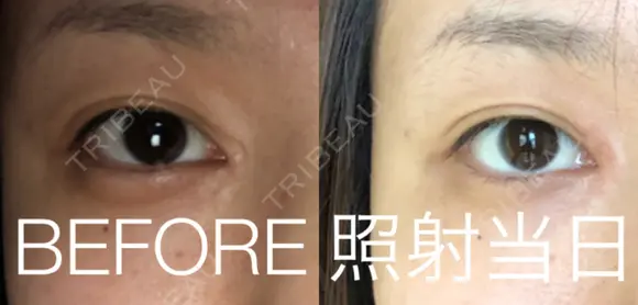 傷跡修正 / ほくろ・いぼ除去レーザー（肌） 山本クリニック BEFORE メイン用