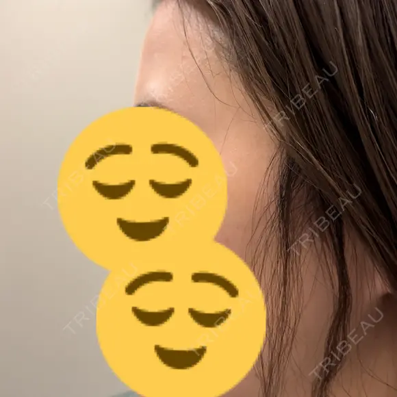 ヒアルロン酸注入（額） ユウコ形成外科クリニック BEFORE メイン用