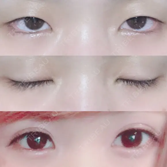 二重埋没 湘南美容クリニック 長野院 BEFORE メイン用