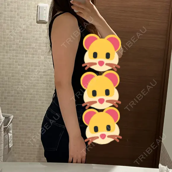 脂肪吸引（二の腕） 湘南美容クリニック 京都院 BEFORE メイン用