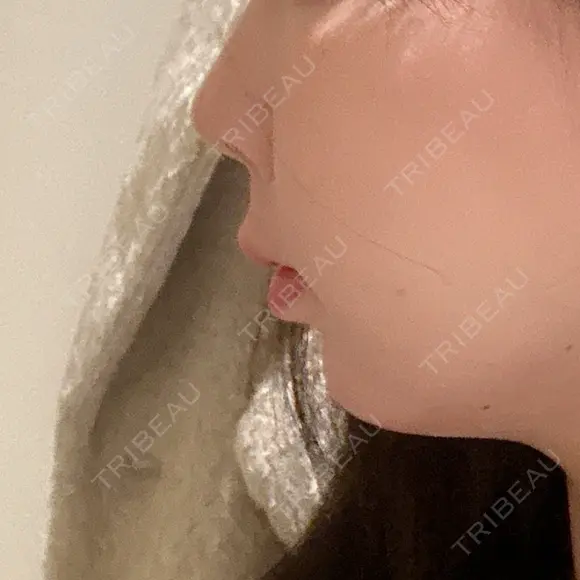 鼻尖形成（切開） / 軟骨移植 / 骨切幅寄せ 9BeautyClinic BEFORE メイン用