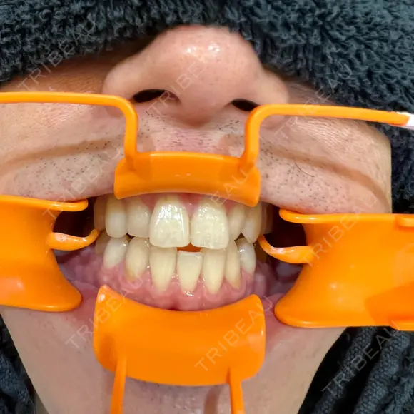 美容点滴・美容注射（ダイエット） / ホワイトニング 麻布シティデンタルクリニック BEFORE メイン用