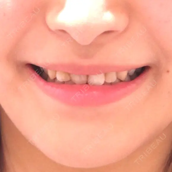 セラミック / その他（審美歯科/矯正歯科） 東京美容外科 赤坂院 BEFORE メイン用