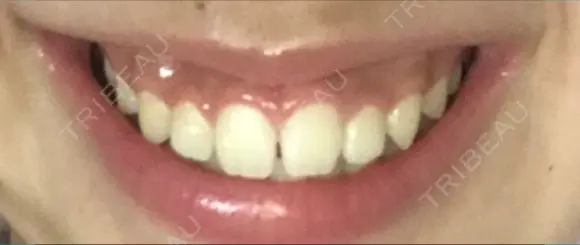 ガミースマイル手術 有楽町美容外科クリニック BEFORE メイン用