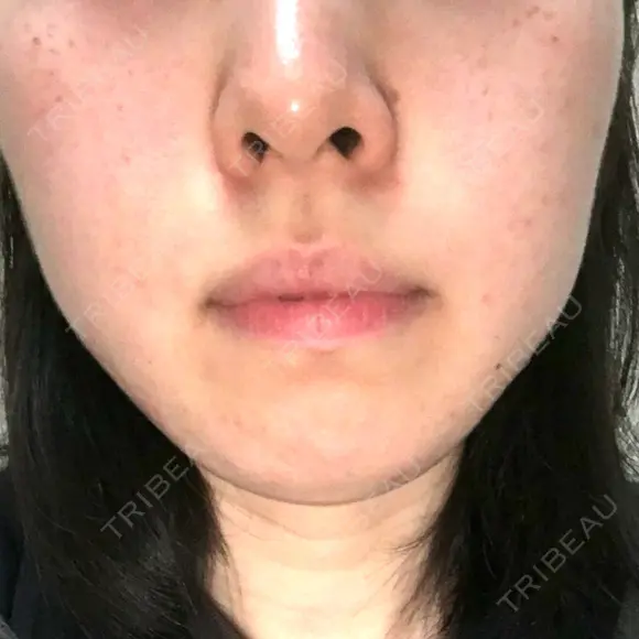脂肪溶解注射（顔） 湘南美容クリニック 大宮院 BEFORE メイン用