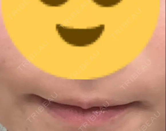 ヒアルロン酸注入（涙袋） / ヒアルロン酸注入（唇） 東京シンデレラ美容外科 大宮院 BEFORE メイン用