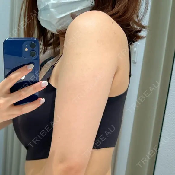 脂肪吸引（二の腕） Mods Clinic（モッズクリニック） 大阪院 BEFORE メイン用