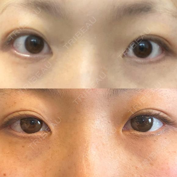 目頭切開 LUHO（ルホ）美容外科 BEFORE メイン用