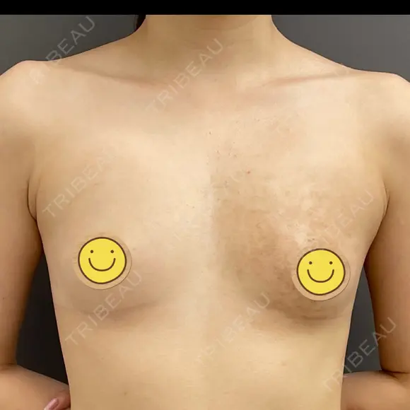 豊胸（シリコンバッグ） / 胸修正 / その他（胸） お茶の水美容形成クリニック BEFORE メイン用