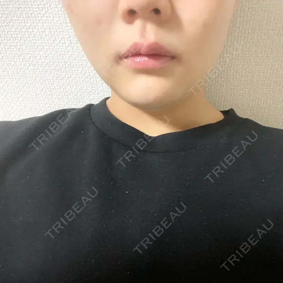 ボトックス（エラ・小顔） / 脂肪溶解注射（顔） TCB東京中央美容外科 京都駅前院 BEFORE メイン用