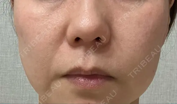 ピーリング（ハリ・ツヤ） LIFIX BEAUTY CLINIC BEFORE メイン用