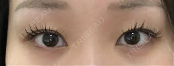 二重埋没 藤・ナチュレ美容クリニック 銀座院 BEFORE メイン用