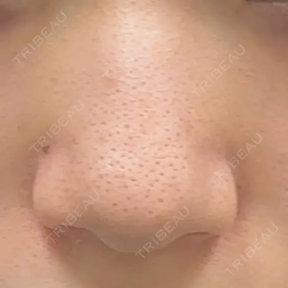 鼻尖形成（切開） / 小鼻縮小（切開） / その他（鼻） 東京形成美容外科 船橋院 BEFORE メイン用