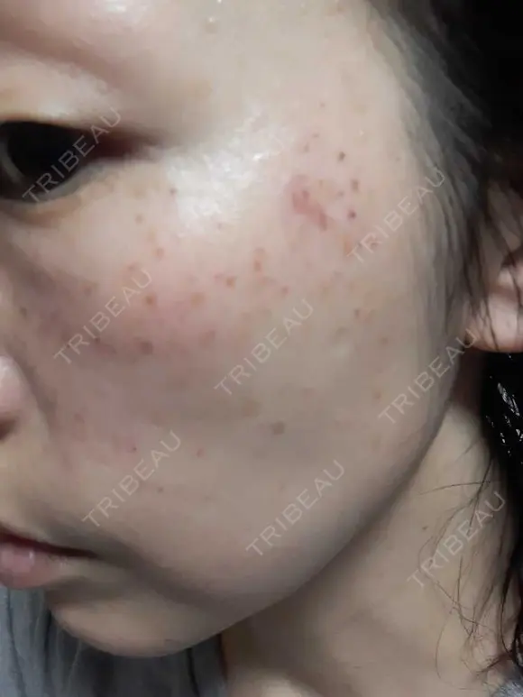 光治療（フォトフェイシャルなど） DMTC美容皮膚科 大宮院 BEFORE メイン用