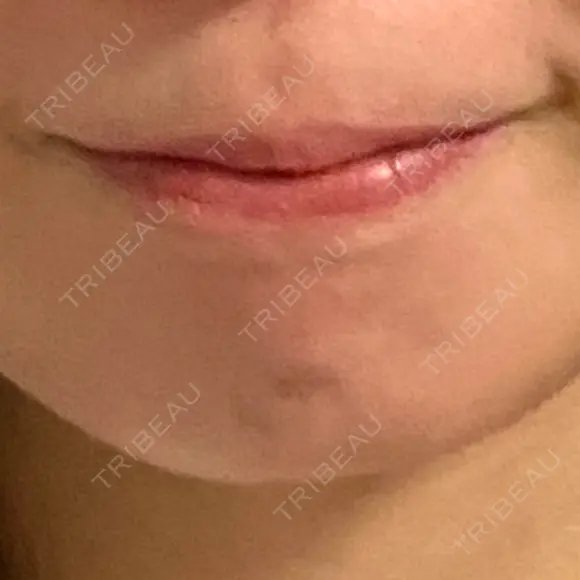 ボトックス（あご） ルラ美容クリニック 池袋院 BEFORE メイン用