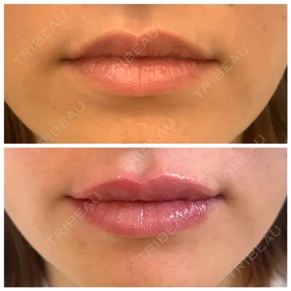 ヒアルロン酸注入（唇） 麻布十番クレールデンタルクリニック BEFORE メイン用