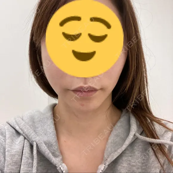 ボトックス（エラ・小顔） ルラ美容クリニック 大宮院 / ルラスキンクリニック 大宮院 BEFORE メイン用