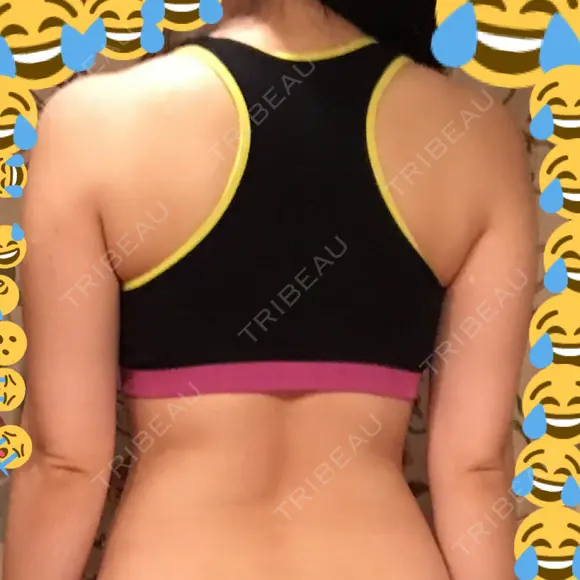 脂肪吸引（二の腕） / 脂肪溶解注射（二の腕） THE SKINNY CLINIC（ザ・スキニークリニック） BEFORE メイン用