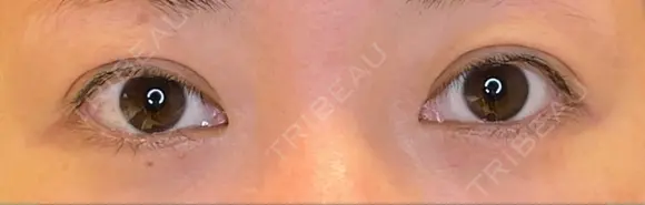 目頭切開 / タレ目形成・グラマラスライン（埋没） LOUIS CLINIC 二子玉川院【ルイクリニック】 BEFORE メイン用