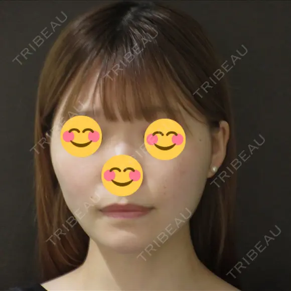 骨切り（あご） / 骨削り（エラ） / 骨削り（頬） / その他（輪郭） / ヒアルロン酸溶解 アーククリニック BEFORE メイン用