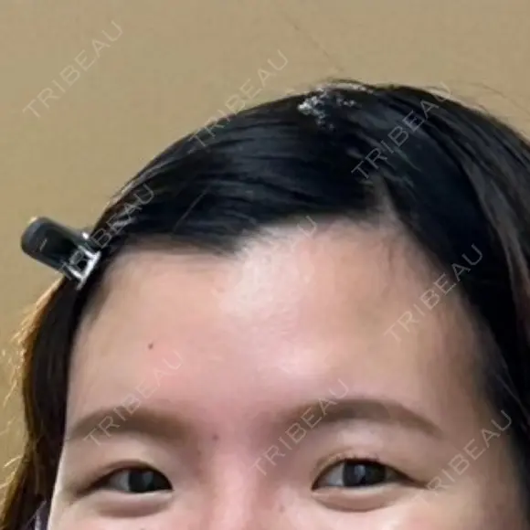 二重埋没 水の森美容クリニック 大阪梅田院 BEFORE メイン用